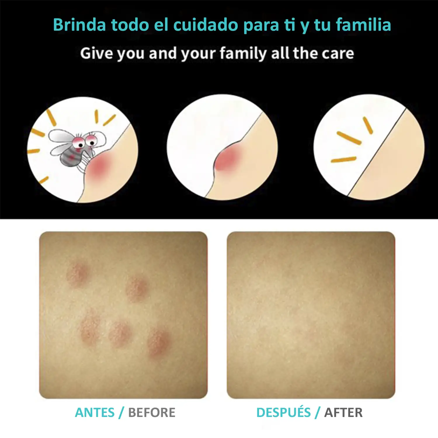 Alivio de picaduras y mordeduras de insectos. Tratamiento sin productos químicos de las picaduras y mordeduras.