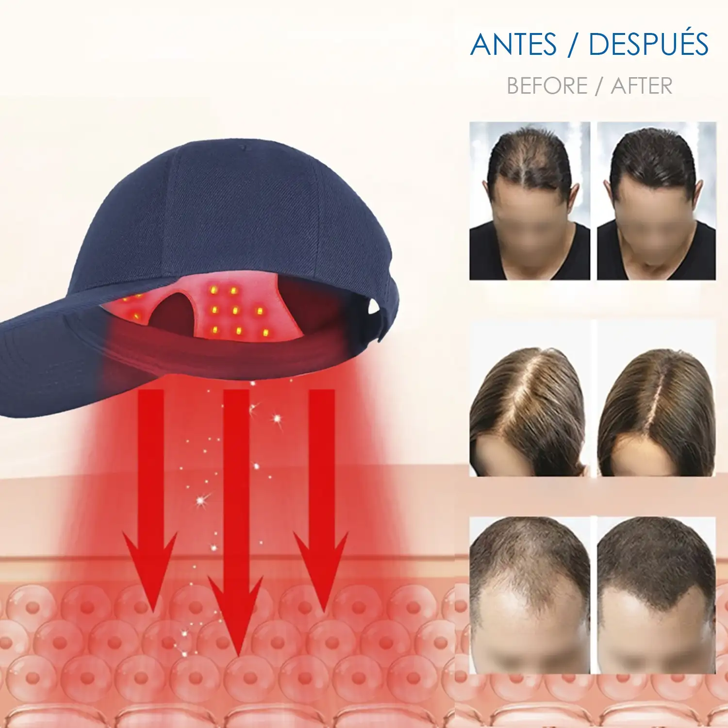 Gorra masajeadora con tratamiento capilar por luz LED. Mejora circulación, ayuda a fortalecer y anti-caída.